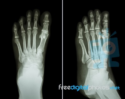 Film X-ray Both Foot ( 2 Position : Front View And Side View ) Stock Photo