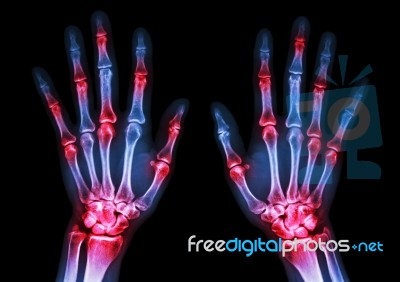 Film X-ray Both Human's Hands And Arthritis At Multiple Joint (gout,rheumatoid) Stock Photo