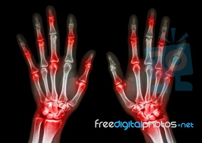 Film X-ray Both Human's Hands And Arthritis At Multiple Joint (gout,rheumatoid) Stock Photo