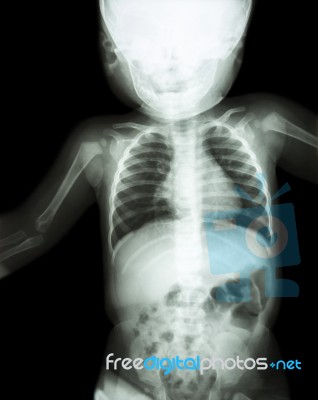 Film X-ray Child 's Body ( Normal Baby ) Stock Photo