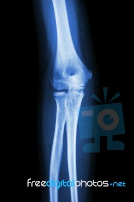 Film X-ray Elbow Ap : Show Normal Human's  Elbow Stock Photo