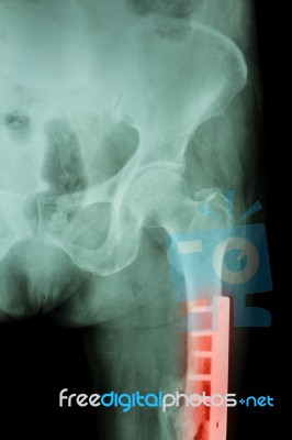 Film X-ray Fracture Femur(thigh Bone). It Was Operated And Inter… Stock Photo