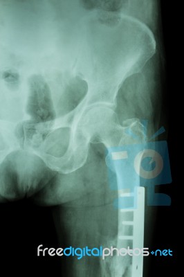 Film X-ray Fracture Femur(thigh Bone). It Was Operated And Inter… Stock Photo