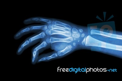 Film X-ray Hand Of Child ( Oblique View ) Stock Photo