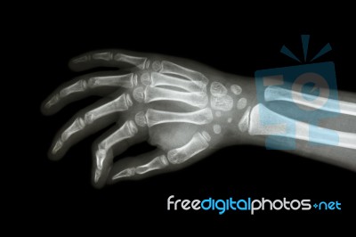 Film X-ray Hand Of Child ( Oblique View ) Stock Photo