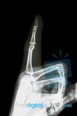 Film X-ray Index Finger And Hand ( Point A Finger ) Stock Photo