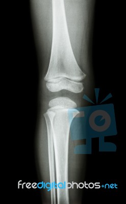 Film X-ray Knee Ap(antero-posterior) Of Child Stock Photo