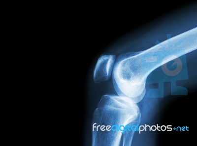 Film X-ray Knee Joint With Arthritis ( Gout , Rheumatoid Arthritis , Septic Arthritis , Osteoarthritis Knee ) And Blank Area At Left Side Stock Photo