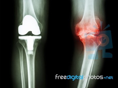 Film X-ray Knee Of Osteoarthritis Knee Patient And Artificial Joint Stock Photo