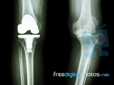 Film X-ray Knee Of Osteoarthritis Knee Patient And Artificial Joint Stock Photo