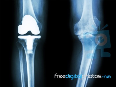 Film X-ray Knee Of Osteoarthritis Knee Patient And Artificial Joint Stock Photo