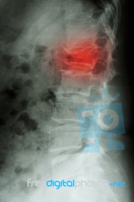 Film X-ray Lumbar Spine Lateral : Show Burst Fracture At Lumbar Stock Photo