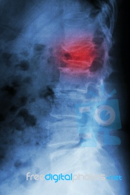 Film X-ray Lumbar Spine Lateral : Show Burst Fracture At Lumbar Stock Photo