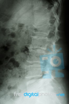 Film X-ray Lumbar Spine Lateral : Show Burst Fracture At Lumbar Stock Photo