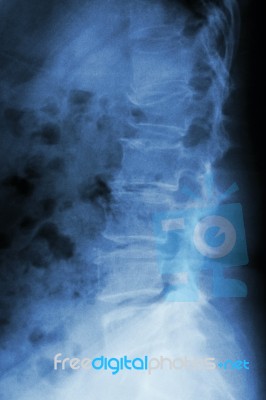 Film X-ray Lumbar Spine Lateral : Show Burst Fracture At Lumbar Stock Photo