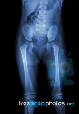 Film X-ray Normal Body Of Child (abdomen,buttock,thigh,knee) Stock Photo