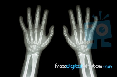 Film X-ray Normal Both Hands Of Child Stock Photo