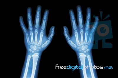 Film X-ray Normal Both Hands Of Child Stock Photo