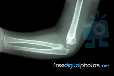 Film X-ray Of Child 's Elbow ( Normal Child 's Elbow ) ( Side View , Lateral ) Stock Photo