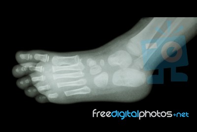 Film X-ray Of Child 's Foot ( Side View ) ( Lateral ) Stock Photo