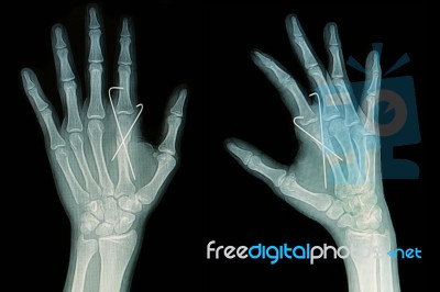 Film X-ray Of Hand Fracture  Insert K-wire Stock Photo