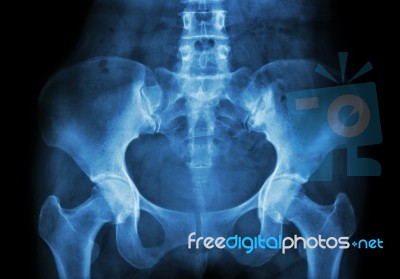 Film X-ray Of Pelvis Stock Photo