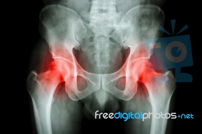 Film X-ray Pelvis And Arthritis Both Hip Stock Photo