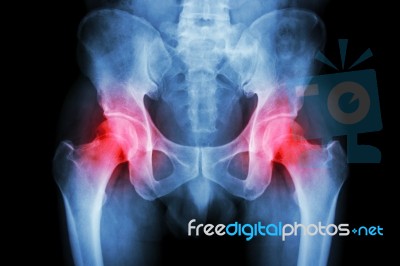 Film X-ray Pelvis And Arthritis Both Hip Stock Photo