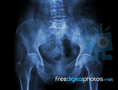 Film X-ray Pelvis Of Osteoporosis Patient Stock Photo