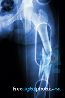 Film X-ray Show Comminute Fracture Shaft Of Femur (thigh Bone). It Was Spliced Stock Photo