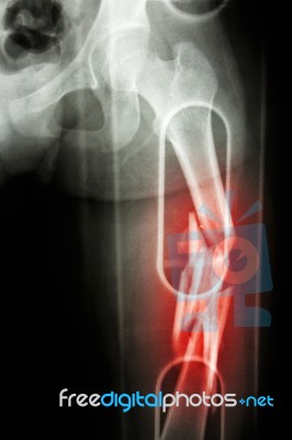 Film X-ray Show Comminute Fracture Shaft Of Femur (thigh Bone). It Was Spliced Stock Photo