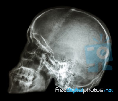 Film X-ray Skull Lateral : Show Normal Human's Skull (thai Peopl… Stock Photo