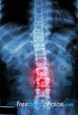 Film X-ray T-l Spine(thoracic-lumbar Spine) Show : Human's Thoracic-lumbar Spine And Inflammation At Lumbar Spine Stock Photo