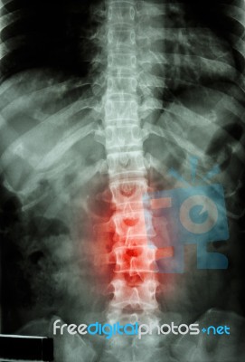 Film X-ray T-l Spine(thoracic-lumbar Spine) Show : Human's Thoracic-lumbar Spine And Inflammation At Lumbar Spine Stock Photo