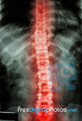 Film X-ray T-l Spine(thoracic-lumbar Spine) Show : Human's Thoracic-lumbar Spine And Inflammation At Spine Stock Photo