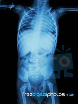 Film X-ray Whole Body Of Child ( Medical , Science And Healthcare Concept ) Stock Photo