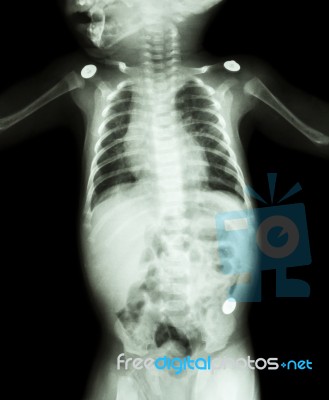 Film X-ray Whole Body Of Infant Stock Photo