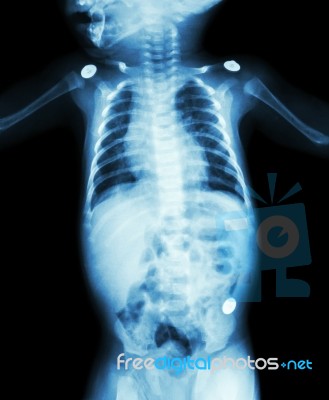 Film X-ray Whole Body Of Infant Stock Photo