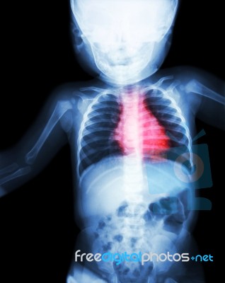 Film X-ray Whole Child 's Body With Heart Disease ( Rheumatic Heart Disease , Valvular Heart Disease ) ( Cardiovascular System ) Stock Photo