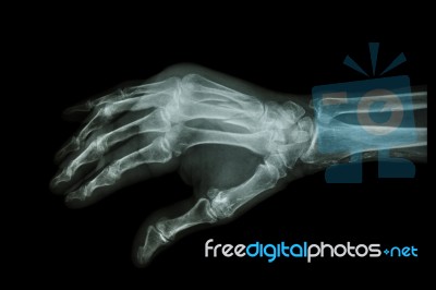 Fracture At 3rd And 4th Metacarpal Bone Stock Photo