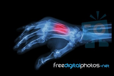 Fracture At 3rd And 4th Metacarpal Bone Stock Photo