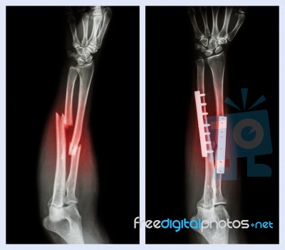 Fracture Both Bone Of Forearm. It Was Operated And Internal Fixed With Plate And Screw (left Image : Before Operation , Right Image : After Operation) Stock Photo