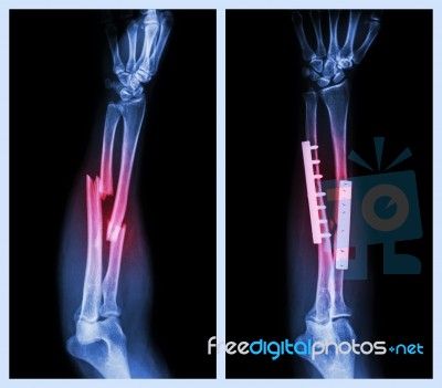 Fracture Both Bone Of Forearm. It Was Operated And Internal Fixed With Plate And Screw (left Image : Before Operation , Right Image : After Operation) Stock Photo