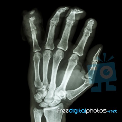 Fracture Distal Pharange Little Finger Stock Photo