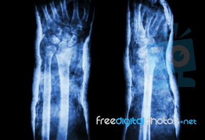 Fracture Distal Radius (colles' Fracture) And Cast (front & Side) Stock Photo