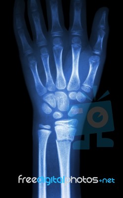 Fracture Distal Radius (forearm's Bone) Stock Photo