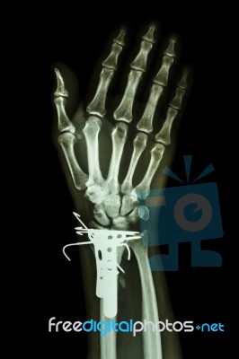 Fracture Distal Radius (forearm's Bone). It Was Operated And Ins… Stock Photo