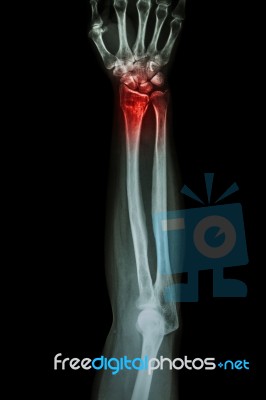 Fracture Distal Radius (wrist Bone) ,(colles' Fracture) Stock Photo