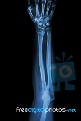 Fracture Distal Radius (wrist Bone) ,(colles' Fracture) Stock Photo