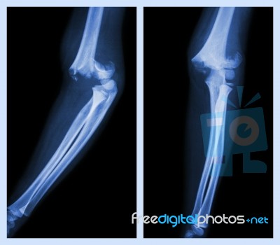 Fracture Elbow (left Image : Side Position , Right Image : Front Position) Stock Photo